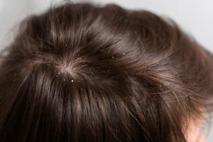 cara menghilangkan ketombe dan rambut rontok