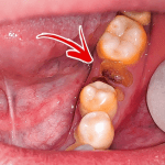 cara mengatasi gusi bolong setelah cabut gigi