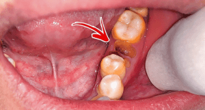 cara mengatasi gusi bolong setelah cabut gigi